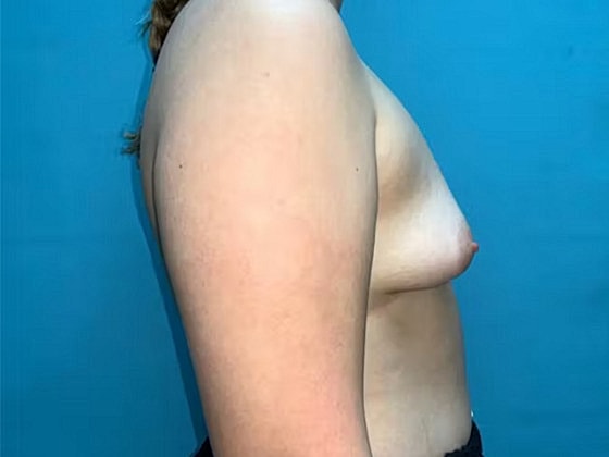 Breast Augmentation Before & After