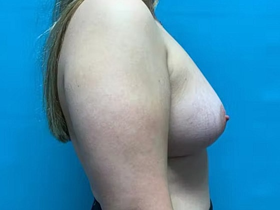 Breast Augmentation Before & After
