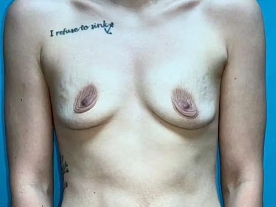 Breast Augmentation Before & After
