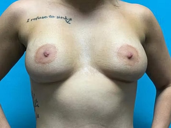 Breast Augmentation Before & After