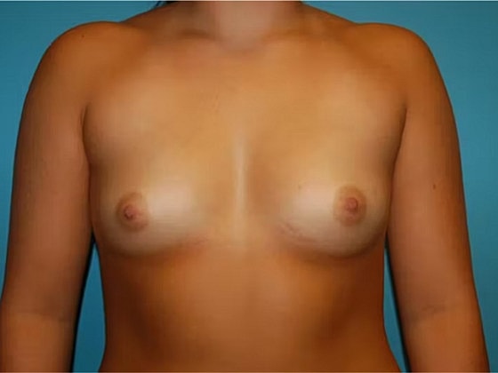 Breast Augmentation Before & After