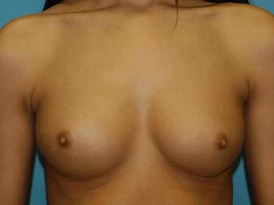 Breast Augmentation Before & After