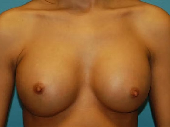 Breast Augmentation Before & After
