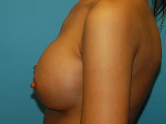 Breast Augmentation Before & After