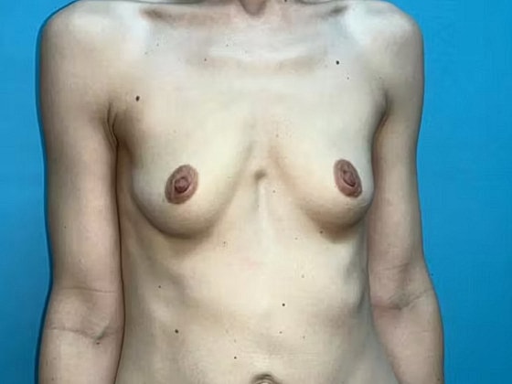 Breast Augmentation Before & After