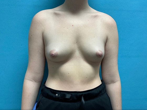 Breast Augmentation Before & After