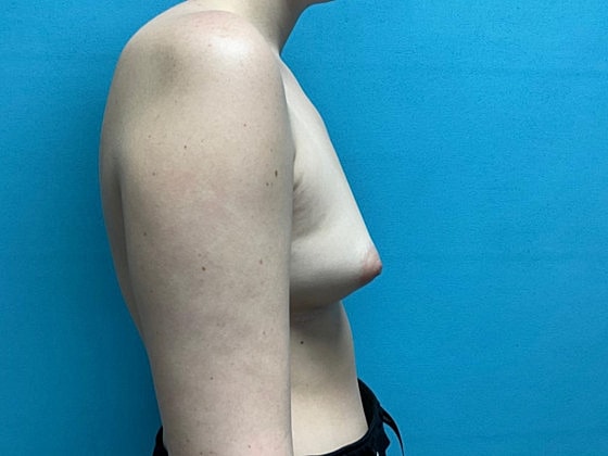 Breast Augmentation Before & After