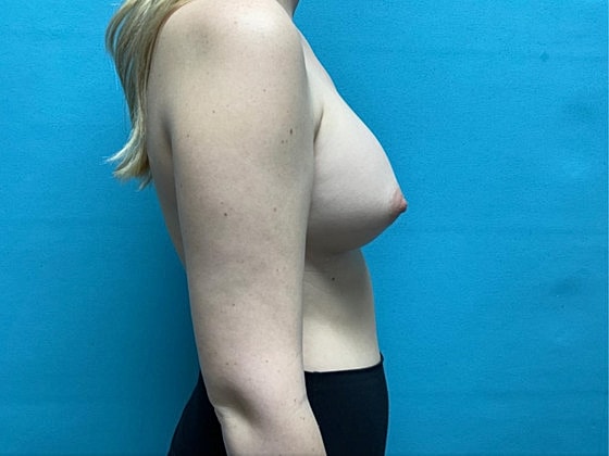 Breast Augmentation Before & After