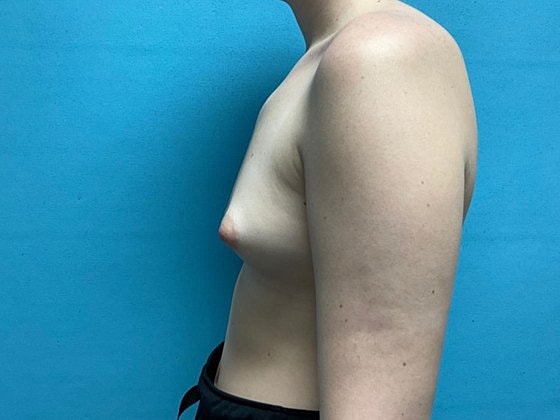 Breast Augmentation Before & After