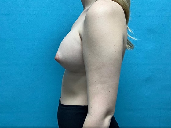 Breast Augmentation Before & After