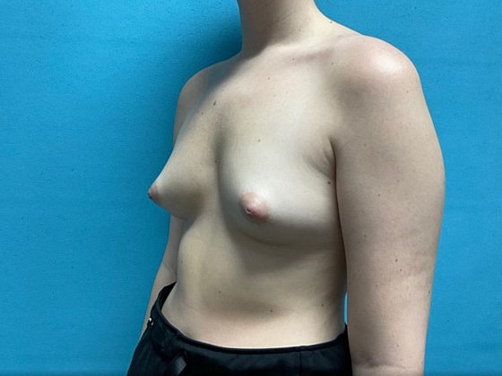 Breast Augmentation Before & After