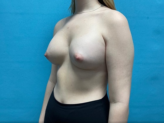 Breast Augmentation Before & After