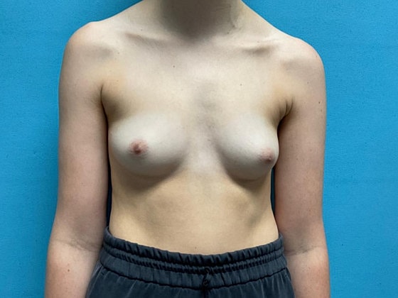 Breast Augmentation Before & After