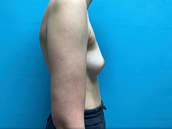 Breast Augmentation Before & After
