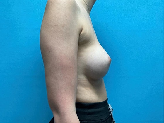 Breast Augmentation Before & After