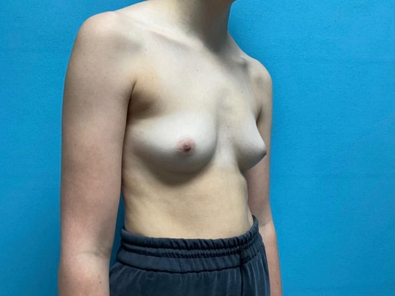 Breast Augmentation Before & After