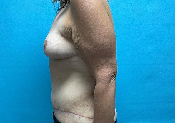 Mommy Makeover Before & After