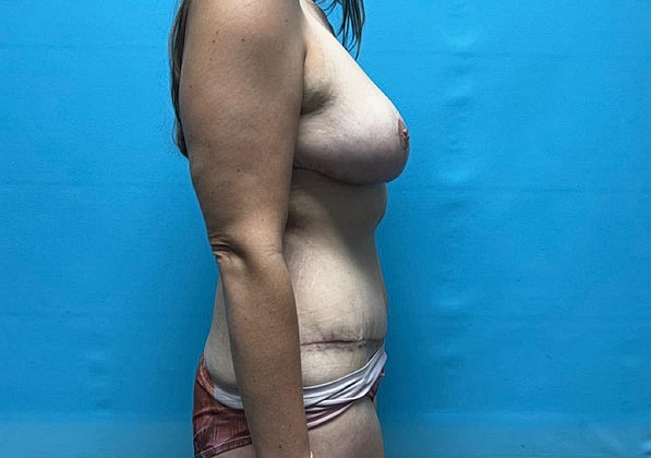 Mommy Makeover Before & After