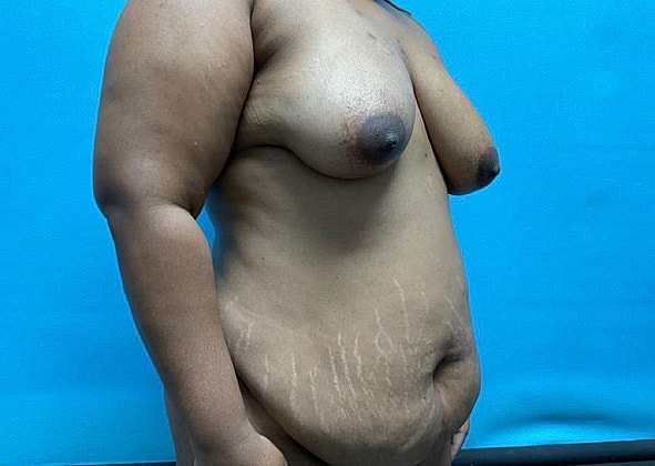 Mommy Makeover Before & After