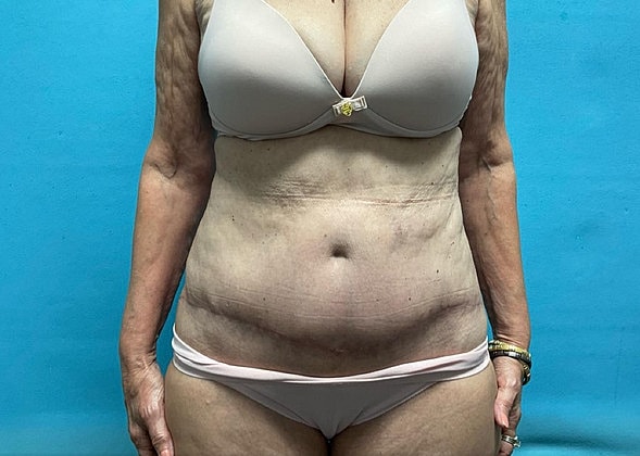 Mommy Makeover Before & After