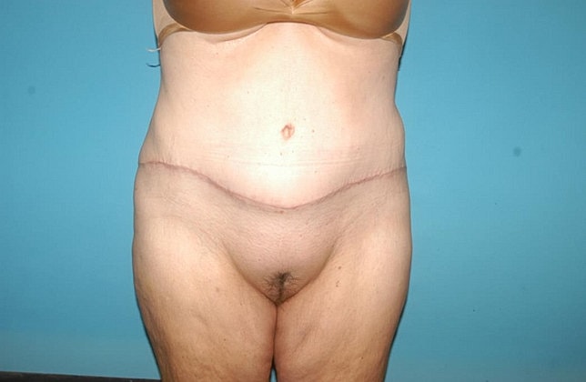 Mommy Makeover Before & After