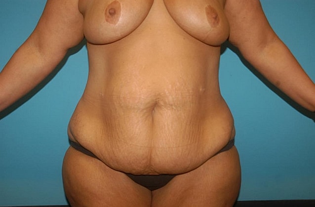 Mommy Makeover Before & After
