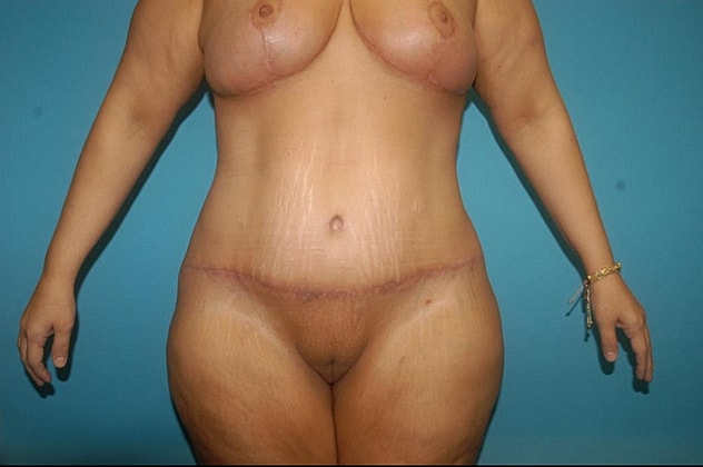 Mommy Makeover Before & After