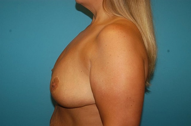 Mommy Makeover Before & After
