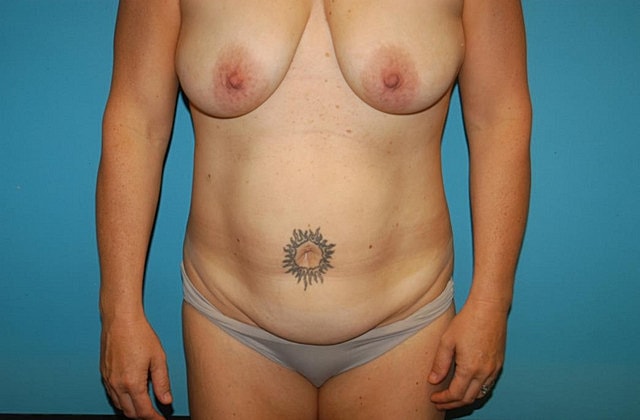 Mommy Makeover Before & After