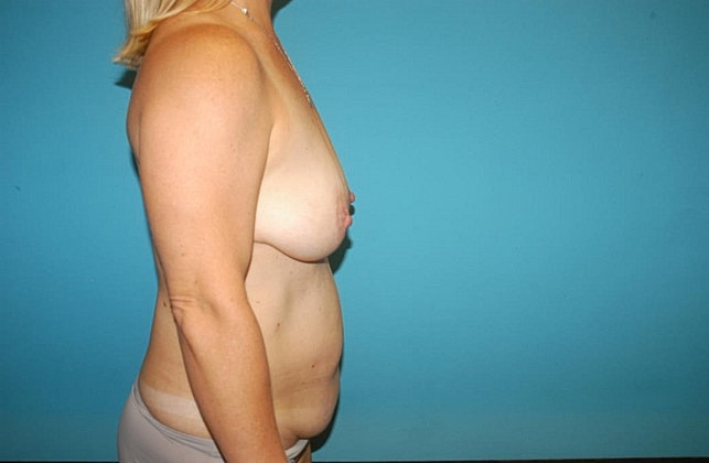 Mommy Makeover Before & After