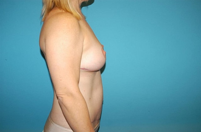 Mommy Makeover Before & After