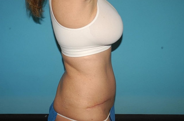 Mommy Makeover Before & After