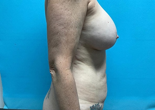 Mommy Makeover Before & After