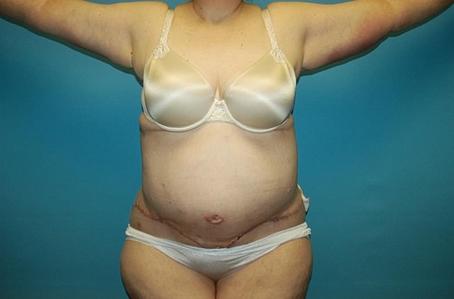 Mommy Makeover Before & After