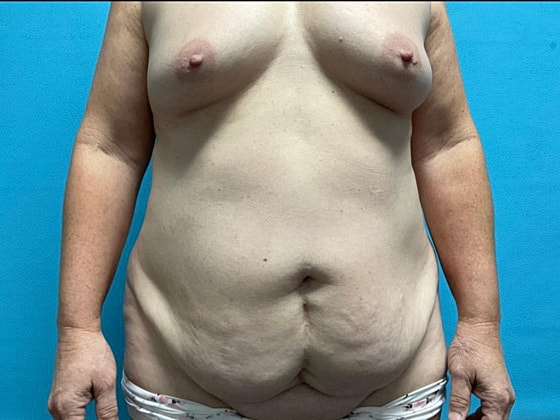 Mommy Makeover Before & After