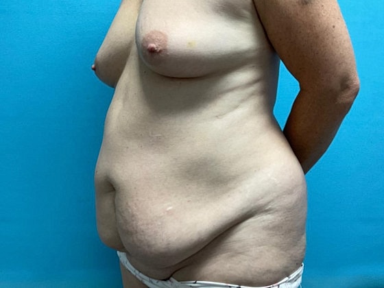 Mommy Makeover Before & After