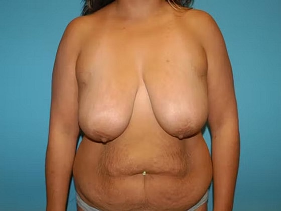 Mommy Makeover Before & After