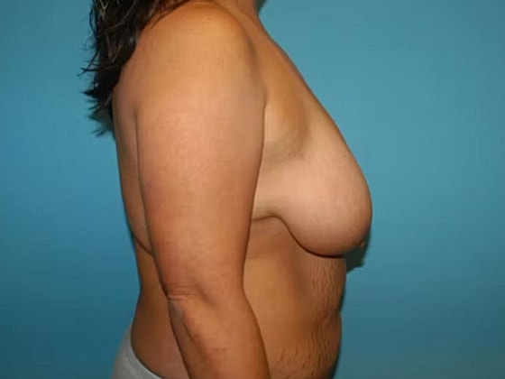 Mommy Makeover Before & After