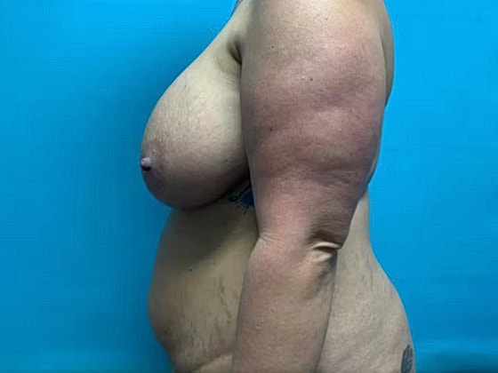 Mommy Makeover Before & After