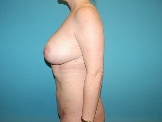 Mommy Makeover Before & After