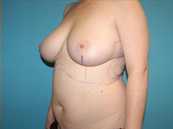 Mommy Makeover Before & After