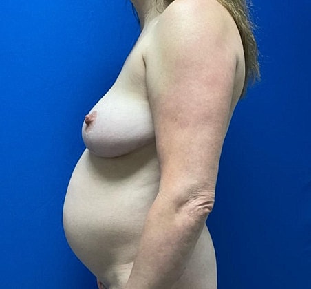 Mommy Makeover Before & After
