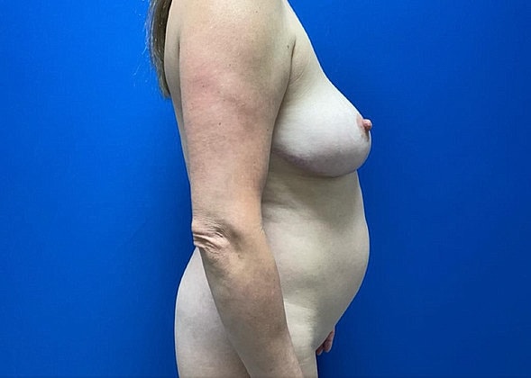 Mommy Makeover Before & After