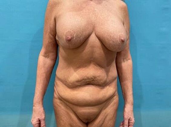Mommy Makeover Before & After