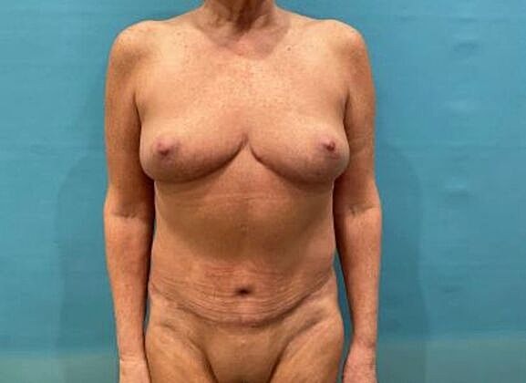 Mommy Makeover Before & After