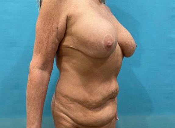 Mommy Makeover Before & After