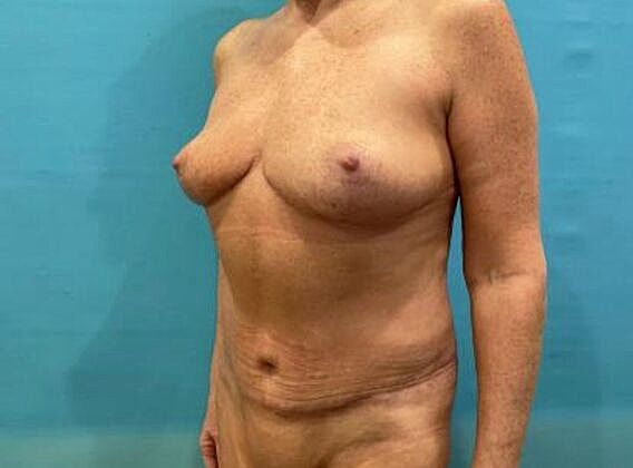 Mommy Makeover Before & After