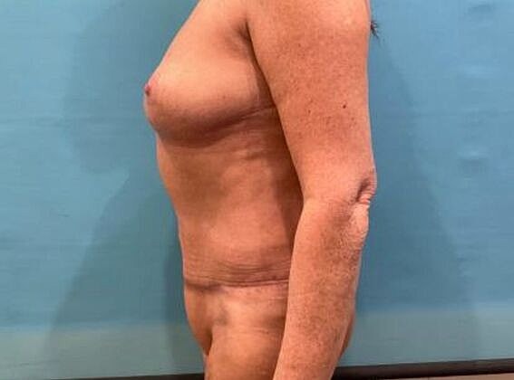 Mommy Makeover Before & After