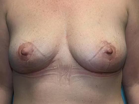 Breast Lift Before & After
