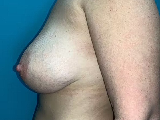 Breast Lift Before & After